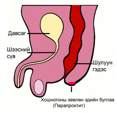 Хатиг/Парапроктит дахидаг уу?