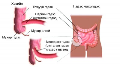 Нэмэлт хоолонд оруулах үед хүүхдийн гэдэс чихэлдэх аюултай юу?